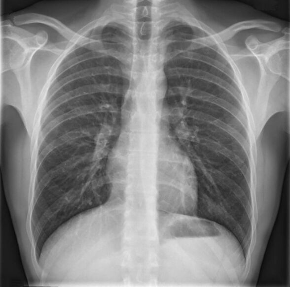 La osteocondrosis de la columna torácica se diagnostica mediante radiografía.