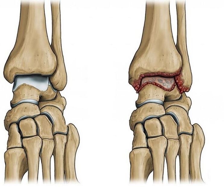 osteoartritis de la articulación del tobillo