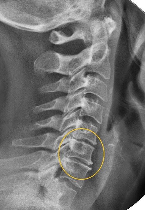 osteocondrosis