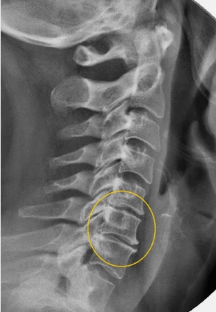 Osteocondrosis de la columna cervical en una raya x