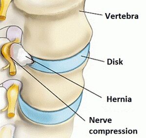 Osteocondrosis de la región cervical