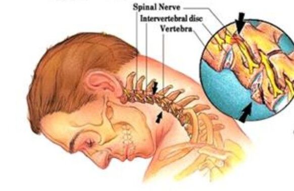 osteocondrosis cervical