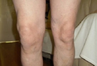 manifestaciones de artrosis de la articulación de la rodilla (1)