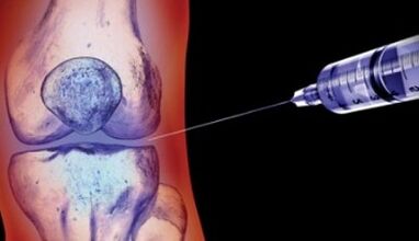 métodos para tratar la artrosis articular