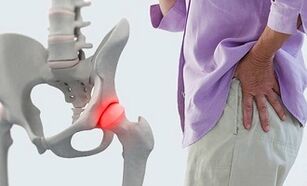 causas de la artrosis de la articulación de la cadera