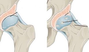 etapas de desarrollo de la artrosis de cadera