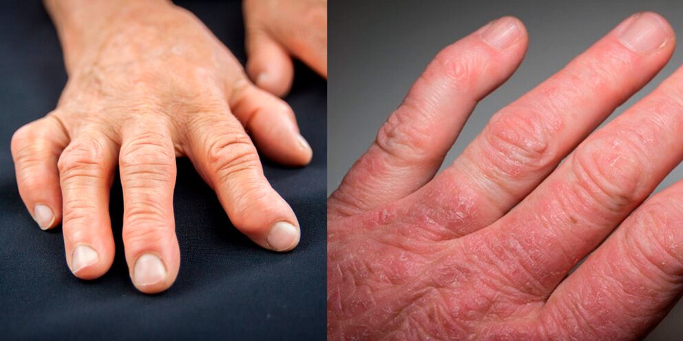 artritis reumatoide y psoriásica de las manos