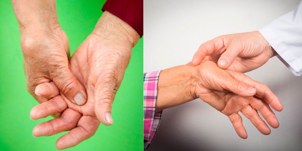 hinchazón y dolor son los primeros signos de artritis de la mano