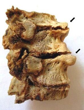 Sección vertebral afectada por osteocondrosis