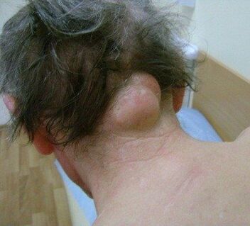 neoplasia como causa de dolor de cuello