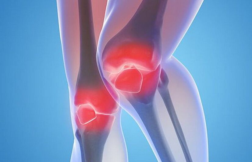 artrosis de las articulaciones de la rodilla