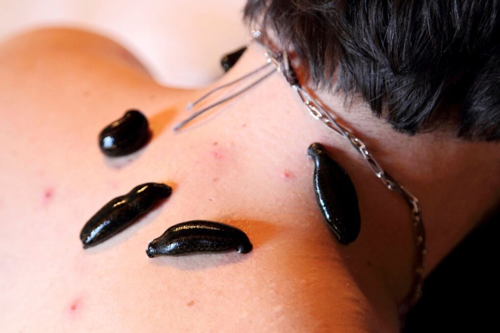 sanguijuelas para la osteocondrosis cervical