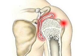 destrucción de la articulación del hombro con artrosis