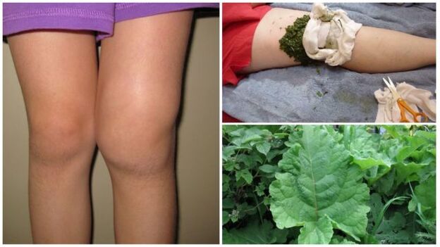 compresa de hierbas para la osteoartritis de la rodilla