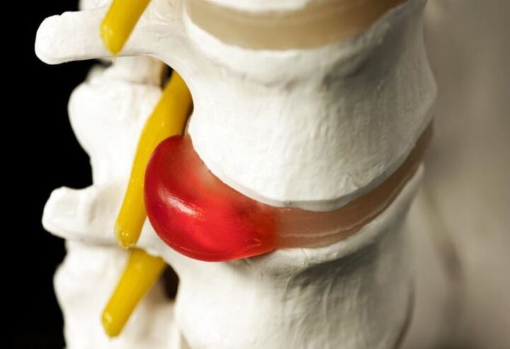 hernia espinal como causa de dolor en los omoplatos