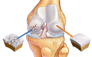 la osteoartritis de la rodilla